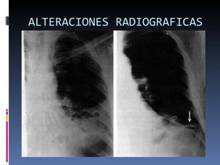 ALTERACIONES RADIOGRAFICAS 