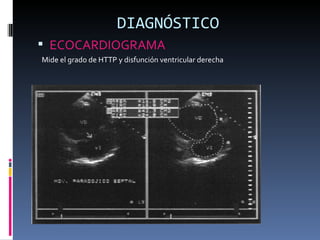 DIAGNÓSTICO ECOCARDIOGRAMA  Mide el grado de HTTP y disfunción ventricular derecha 