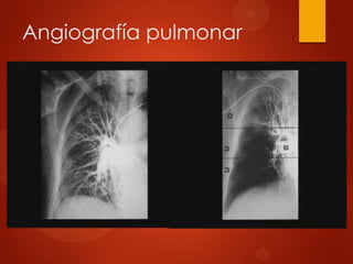 Angiografía pulmonar
 