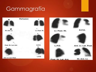Gammagrafía
 
