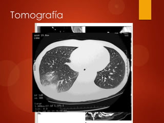 Tomografía
 