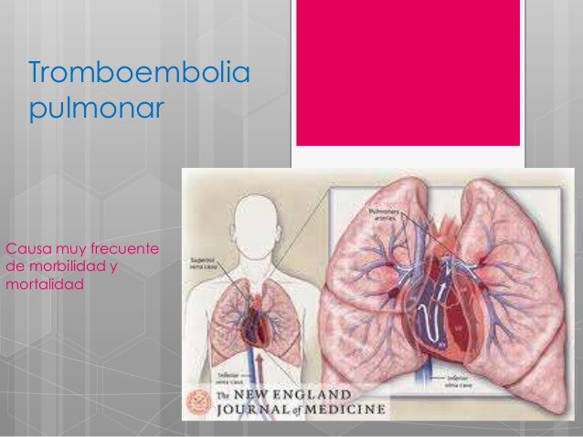 Tromboembolia pulmonar