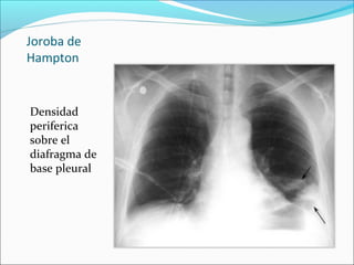Tromboembolia Pulmonar PPT Tromboembolia Pulmonar PPT