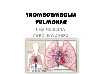 Tromboembolia
Pulmonar
UVM medicina
Carolina Jasso
 