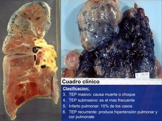 Clasificacion:  TEP masivo: causa muerte o choque TEP submasivo: es el mas frecuente Infarto pulmonar: 10% de los casos TEP recurrente: produce hipertensión pulmonar y cor pulmonale Cuadro clínico  