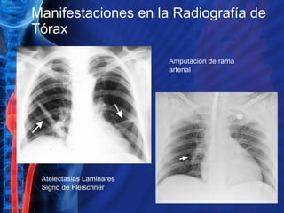 Manifestaciones en la Radiografía de Tórax Atelectasias Laminares Signo de Fleischner Amputación de rama arterial 