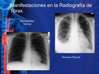 Manifestaciones en la Radiografía de Tórax Hiperclaridad  Normal Derrame Pleural 