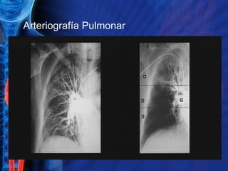 Arteriografía Pulmonar 