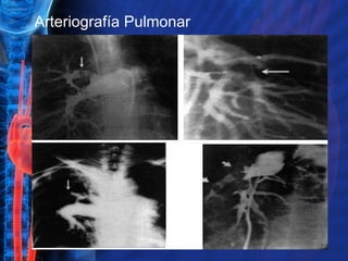 Arteriografía Pulmonar 