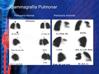 Gammagrafía Pulmonar Perfusoria Normal Perfusoria Anormal 