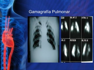 Gamagrafía Pulmonar 
