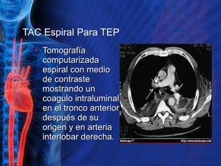 TAC Espiral Para TEP Tomografía computarizada espiral con medio de contraste mostrando un coagulo intraluminal en el tronco anterior después de su origen y en arteria interlobar derecha . 