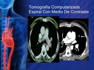 Tomografía Computarizada Espiral Con Medio De Contraste 
