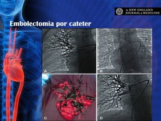 Embolectomia por cateter 