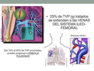 • 25% de TVP no tratados
                                     se extienden a las VENAS
                                       DEL SISTEMA ILEO-
                                             FEMORAL




Del 10% al 40% de TVP proximales,
  pueden progresar a EMBOLIA
           PULMONAR
 