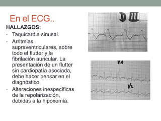 En el ECG..
HALLAZGOS:
• Taquicardia sinusal.
• Arritmias
  supraventriculares, sobre
  todo el flutter y la
  fibrilación auricular. La
  presentación de un flutter
  sin cardiopatía asociada,
  debe hacer pensar en el
  diagnóstico.
• Alteraciones inespecíficas
  de la repolarización,
  debidas a la hipoxemia.
 