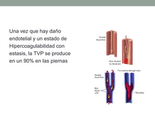 Una vez que hay daño
endotelial y un estado de
Hipercoagulabilidad con
estasis, la TVP se produce
en un 90% en las piernas
 