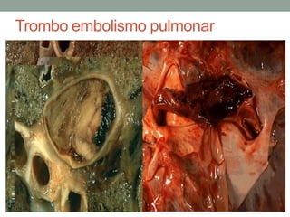 Trombo embolismo pulmonar
 