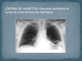 Radiografia Y Tromboembolismo Pulmonar PPTX Radiografia Y Tromboembolismo Pulmonar PPTX
