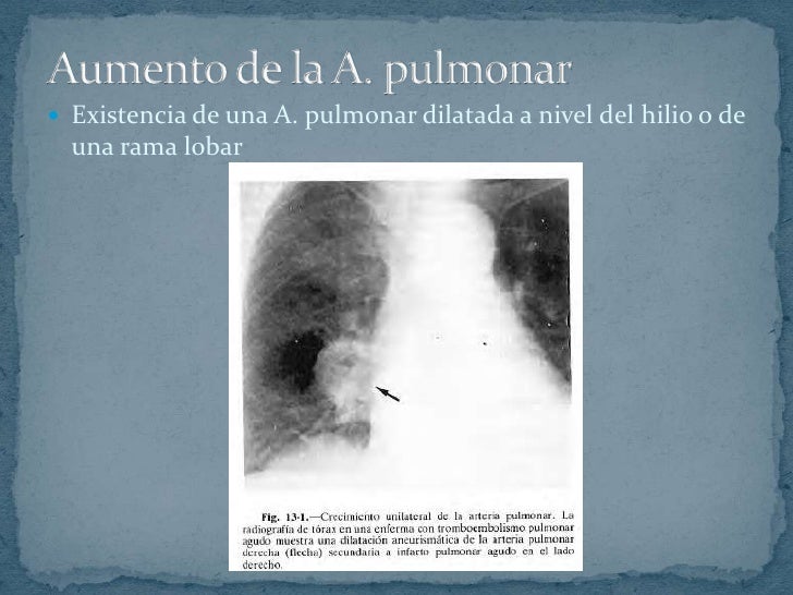 Imagenes Radiograficas Pdf | radiografia y tromboembolismo pulmonar Imagenes Radiograficas Pdf | radiografia y tromboembolismo pulmonar