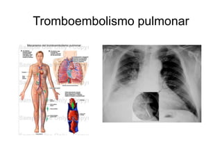 Tromboembolismo pulmonar 
 