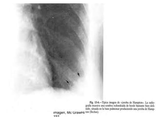 Tromboembolismo pulmonar 