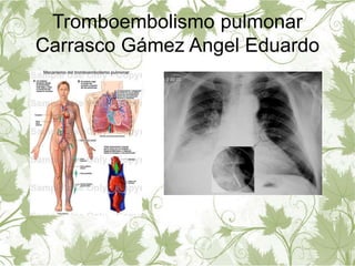 Tromboembolismo pulmonar 
Carrasco Gámez Angel Eduardo 
 