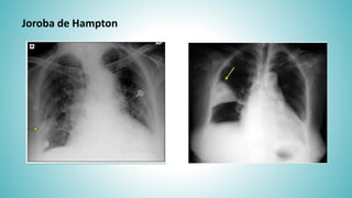 Tromboembolismo Pulmonar Revisi n 2015 PPTX Tromboembolismo Pulmonar Revisi n 2015 PPTX
