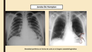 Tromboembolismo Pulmonar PPTX Tromboembolismo Pulmonar PPTX
