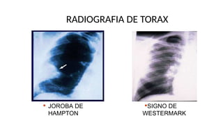 TROMBOEMBOLISMO PULMONAR DIAPOSITIVAS PPTX TROMBOEMBOLISMO PULMONAR DIAPOSITIVAS PPTX