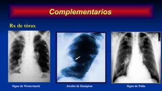 Rx de tórax
Joroba de Hampton Signo de Palla
Signo de Westermark
Complementarios
 