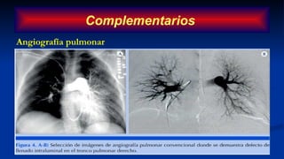 Angiografía pulmonar
Complementarios
 