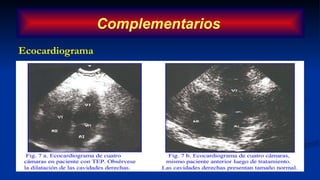 Ecocardiograma
Complementarios
 