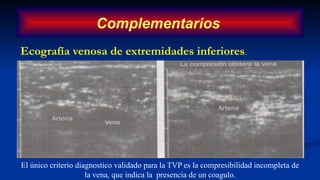 Ecografía venosa de extremidades inferiores.
Complementarios
El único criterio diagnostico validado para la TVP es la compresibilidad incompleta de
la vena, que indica la presencia de un coagulo.
 