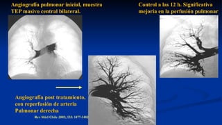 Angiografía pulmonar inicial, muestra
TEP masivo central bilateral.
Control a las 12 h. Significativa
mejoría en la perfusión pulmonar
Angiografía post tratamiento,
con reperfusión de arteria
Pulmonar derecha
Rev Méd Chile 2005; 133: 1477-1482
 