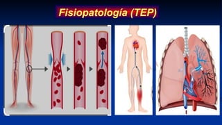 Fisiopatología (TEP)
 
