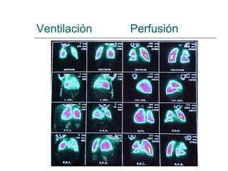 Ventilación  Perfusión 