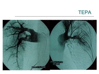 TEPA 