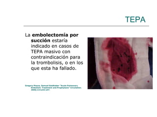 TEPA La  embolectomía por succión  estaría indicado en casos de TEPA masivo con contraindicación para la trombolisis, o en los que esta ha fallado. Gregory Piazza, Samuel Goldhaber “Acute Pulmonary Embolism: Treatment and Prophylaxis” Circulation. 2006;114:e42-e47. 