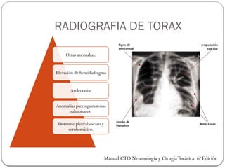 RADIOGRAFIA DE TORAX
Otras anomalías:
Elevación de hemidiafragma
Atelectasias
Anomalías parenquimatosas
pulmonares
Derrame pleural escaso y
serohemático.
Manual CTO Neumología y CirugíaTorácica. 6ª Edición
 