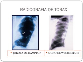 RADIOGRAFIA DE TORAX
 JOROBA DE HAMPTON  SIGNO DEWESTERMARK
 