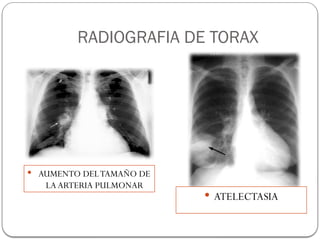 RADIOGRAFIA DE TORAX
 AUMENTO DELTAMAÑO DE
LA ARTERIA PULMONAR
 ATELECTASIA
 