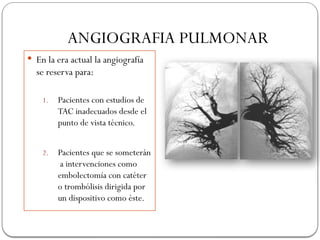 ANGIOGRAFIA PULMONAR
 En la era actual la angiografía
se reserva para:
1. Pacientes con estudios de
TAC inadecuados desde el
punto de vista técnico.
2. Pacientes que se someterán
a intervenciones como
embolectomía con catéter
o trombólisis dirigida por
un dispositivo como éste.
 