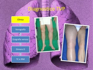 Diagnostico TVP
Clínica
Venografía
Ecografía venosa
Dimero D
TC e IRM
 