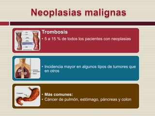 Neoplasias malignas