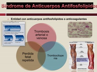 Síndrome de Anticuerpos AntifosfolípidosEntidad con anticuerpos antifosfolípidos o anticoagulantes lúpicos