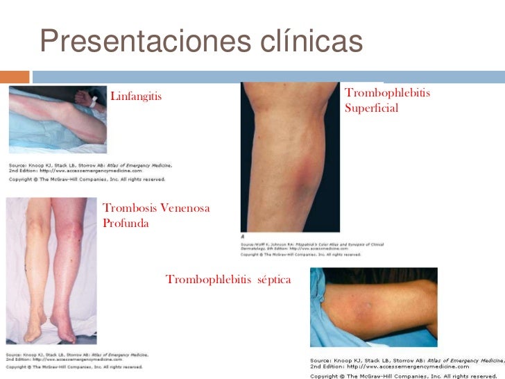 El tratamiento del hinchazón a la tromboflebitis