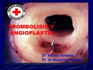 TROMBOLISIS Y
ANGIOPLASTIA



         Dr. Hector Simosa
         R1 de Medicina Interna
                                  1
 