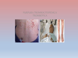 PURPURA TROMBOCITOPENICA
TROMBOTICA
 