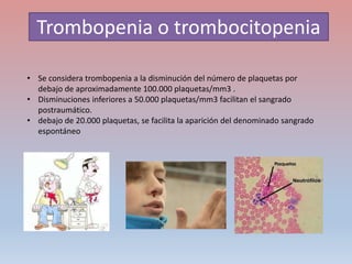 Trombopenia o trombocitopenia
• Se considera trombopenia a la disminución del número de plaquetas por
debajo de aproximadamente 100.000 plaquetas/mm3 .
• Disminuciones inferiores a 50.000 plaquetas/mm3 facilitan el sangrado
postraumático.
• debajo de 20.000 plaquetas, se facilita la aparición del denominado sangrado
espontáneo
 
